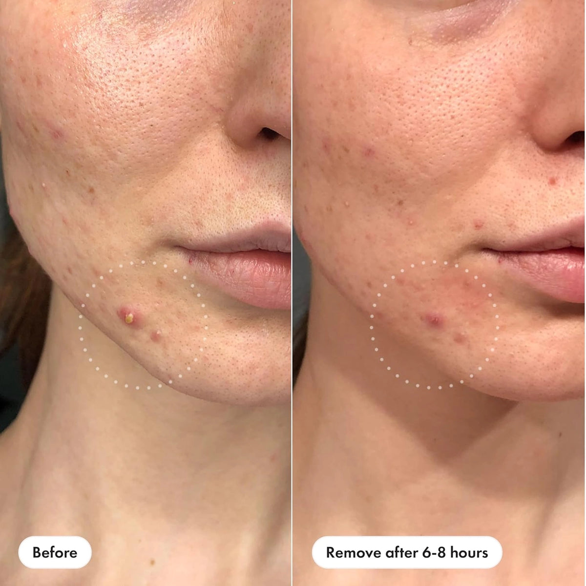 Mighty Patch Pimple Patches - Invisible