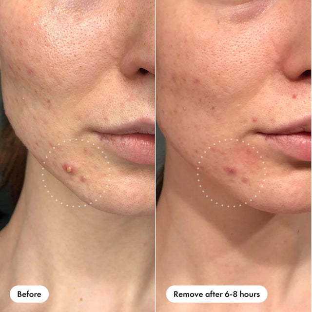 Mighty Patch Pimple Patches - Invisible